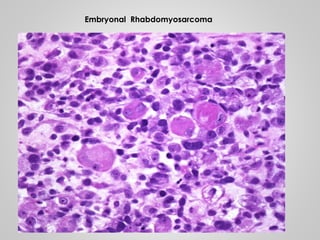 Embryonal Rhabdomyosarcoma
 