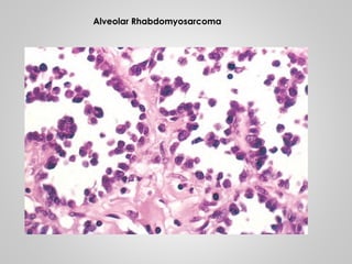 Alveolar Rhabdomyosarcoma
 