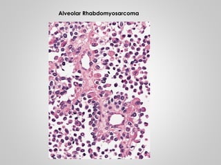 Alveolar Rhabdomyosarcoma
 