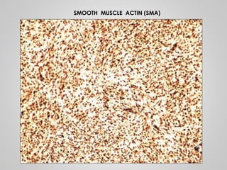 SMOOTH MUSCLE ACTIN (SMA)
 