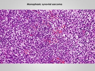 Monophasic synovial sarcoma
 