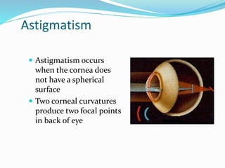 Astigmatism
 Astigmatism occurs
when the cornea does
not have a spherical
surface
 Two corneal curvatures
produce two focal points
in back of eye
 