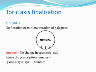Toric axis finalization
 CASE 1
No Rotation or minimal rotation of 5 degrees
Answer - No change in spectacle axis
hence the prescription remains:-
-3.00/-2.25 X 170 8.60mm
 