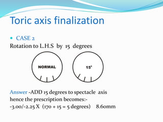 Toric axis finalization
 CASE 2
Rotation to L.H.S by 15 degrees
Answer -ADD 15 degrees to spectacle axis
hence the prescription becomes:-
-3.00/-2.25 X (170 + 15 = 5 degrees) 8.60mm
150
 