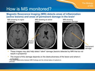 How is MS monitored? Magnetic Resonance Imaging (MRI) detects areas of inflammation (active lesions) and areas of permanent damage in the brain 1 The Biology of MS MRI showing no signs  of damage MRI showing an active lesion* MRI showing  permanent damage Active lesion Permanent damage These images may also help detect “silent” damage (lesions detected by MRI that do not result in symptoms) 1 The impact of this damage depends on the destructiveness of the lesion and where it is located *The exact relationship between MRI findings and the clinical status of patients is unknown. 