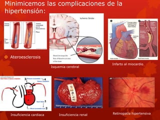Minimicemos las complicaciones de la 
hipertensión: 
 Ateroesclerosis 
Insuficiencia cardiaca Insuficiencia renal 
Infarto al miocardio 
Retinopatía hipertensiva 
Isquemia cerebral 
 