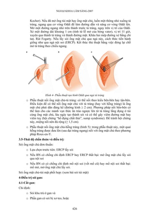 NGOẠI KHOA LÂM SÀNG-2007
Kocher). Nếu đã mở ống túi mật hay ống mật chủ, luồn một thông nhỏ xuống tá
tràng, ngang qua cơ vòng Oddi để làm đường dẫn và nâng cơ vòng Oddi lên.
Mở một đường ngang nhỏ trên thành trước tá tràng, ngay trên vị trí của Oddi.
Xẻ một đường dài khoảng 1 cm (tính từ lỗ mở của bóng vater), vị trí 11 giờ,
xuyên qua thành tá tràng và thành đường mật. Khâu hai mép đường xẻ bằng chỉ
tan. Rút Fogarty. Nếu lấy sỏi ống mật chủ qua ngả này, cách thức tiến hành
giống như qua ngả nội soi (ERCP). Kết thúc thủ thuật bằng việc đóng lại chỗ
mở tá tràng theo chiều ngang.
Hình 4- Phẫu thuật tạo hình Oddi qua ngả tá tràng
o Phẫu thuật nối ống mật chủ-tá tràng: có thể nối theo kiểu bên-bên hay tận-bên.
Điều kiện để có thể nối ống mật chủ với tá tràng (hay với hỗng tràng) là ống
mật chủ phải dãn đáng kể (đường kính ≥ 2 cm). Phương pháp nối bên-bên có
thể làm cho các mảnh vụn thức ăn trào ngược lên từ tá tràng lắng đọng ở túi
cùng ống mật chủ, lâu ngày tạo thành sỏi và có thể gây viêm đường mật hay
viêm tuỵ (hội chứng “hố đựng chất thải”, sump syndrome). Để tránh hội chứng
này, miệng nối nên đủ rộng (≥ 1,5 cm).
o Phẫu thuật nối ống mật chủ-hỗng tràng (hình 5): trong phẫu thuật này, một quai
hỗng tràng được đưa lên (sau đại tràng ngang) nối với ống mật chủ theo phương
pháp Roux-en-Y.
3.5-Thái độ chẩn đoán và điều trị:
Sỏi ống mật chủ đơn thuần:
o Lựa chọn trước tiên: ERCP lấy sỏi
o Nếu BN có chống chỉ định ERCP hay ERCP thất bại: mở ống mật chủ lấy sỏi
qua nội soi
o Nếu BN có có chống chỉ định mổ nội soi (vết mổ cũ) hay mổ nội soi thất bại:
mổ mở, mở ống mật chủ lấy sỏi.
Sỏi ống mật chủ-túi mật phối hợp: (xem bài sỏi túi mật)
4-Điều trị sỏi gan:
4.1-Cắt gan:
Chỉ định:
o Sỏi khu trú ở gan và
o Phần gan có sỏi bị xơ teo, hoặc
426
 