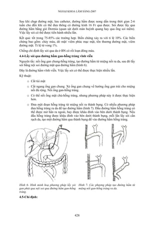 NGOẠI KHOA LÂM SÀNG-2007
Sau khi chụp đường mật, lưu catheter, đường hầm được nong dần trong thời gian 2-6
tuần cho đến khi có thể đưa thông có đường kính 16 Fr qua được. Sỏi được lấy qua
đường hầm bằng giỏ Dormia (quan sát dưới màn huỳnh quang hay qua ống soi mềm).
Việc lấy sỏi có thể được tiến hành nhiều lần.
Kết quả: tốt trong 75-85% các trường hợp. Biến chứng xảy ra với tỉ lệ 10%. Các biến
chứng bao gồm: chảy máu, dò mật/ viêm phúc mạc mật, tổn thương đường mật, viêm
đường mật. Tỉ lệ tử vong 1%.
Chống chỉ định lấy sỏi qua da ở BN có rối loạn đông máu.
4.4-Lấy sỏi qua đường hầm gan-hỗng tràng vĩnh viễn
Nguyên tắc: nối ống gan chung-hỗng tràng, tạo đường hầm từ miệng nối ra da, sau đó lấy
sỏi bằng nội soi đường mật qua đường hầm (hình 6).
Đây là đường hầm vĩnh viễn. Việc lấy sỏi có thể được thực hiện nhiều lần.
Kỹ thuật:
o Cắt túi mật
o Cắt ngang ống gan chung. Xẻ ống gan chung về hướng ống gan trái cho miệng
nối đủ rộng. Nối ống gan-hỗng tràng.
o Có thể nối ống mật chủ-hỗng tràng, nhưng phương pháp này ít được thực hiện
hơn.
o Đưa một đoạn hỗng tràng từ miệng nối ra thành bụng. Có nhiều phương pháp
đưa hỗng tràng ra da để tạo đường hầm (hình 7). Đầu đường hầm hỗng tràng có
thể được mở hẳn ra ngoài, hay được khâu đính vào bên dưới thành bụng. Nếu
đầu hỗng tràng được khâu đính vào bên dưới thành bụng, mỗi lần lấy sỏi cần
rạch da, tạo một đường hầm qua thành bụng để vào đường hầm hỗng tràng.
Hình 6- Hình minh hoạ phương pháp lấy sỏi
gan phải qua nội soi qua đường hầm gan-hỗng
tràng.
Hình 7- Các phương pháp tạo đường hầm từ
miệng nối gan-hỗng tràng ra da.
4.5-Chỉ định:
428
 