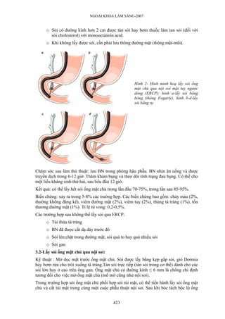 NGOẠI KHOA LÂM SÀNG-2007
o Sỏi có đường kính hơn 2 cm được tán sỏi hay bơm thuốc làm tan sỏi (đối với
sỏi cholesterol) với monooctanoin acid.
o Khi không lấy được sỏi, cần phải lưu thông đường mật (thông mật-mũi).
Hình 2- Hình minh hoạ lấy sỏi ống
mật chủ qua nội soi mật tuỵ ngược
dòng (ERCP): hình a-lấy sỏi bằng
bóng (thông Fogarty), hình b-d-lấy
sỏi bằng rọ
Chăm sóc sau làm thủ thuật: lưu BN trong phòng hậu phẫu. BN nhịn ăn uống và được
truyền dịch trong 6-12 giờ. Thăm khám bụng và theo dõi tình trạng đau bụng. Có thể cho
một liều kháng sinh thứ hai, sau liều đầu 12 giờ.
Kết quả: có thể lấy hết sỏi ống mật chủ trong lần đầu 70-75%, trong lần sau 85-95%.
Biến chứng: xảy ra trong 5-8% các trường hợp. Các biến chứng bao gồm: chảy máu (2%,
thường không đáng kể), viêm đường mật (2%), viêm tuỵ (2%), thủng tá tràng (1%), tổn
thương đường mật (1%). Tỉ lệ tử vong: 0,2-0,5%.
Các trường hợp sau không thể lấy sỏi qua ERCP:
o Túi thừa tá tràng
o BN đã được cắt dạ dày trước đó
o Sỏi lèn chặt trong đường mật, sỏi quá to hay quá nhiều sỏi
o Sỏi gan
3.2-Lấy sỏi ống mật chủ qua nội soi:
Kỹ thuật : Mở dọc mặt trước ống mật chủ. Sỏi được lấy bằng kẹp gắp sỏi, giỏ Dormia
hay bơm rửa cho trôi xuống tá tràng.Tán sỏi trực tiếp (tán sỏi trong cơ thể) dành cho các
sỏi lớn hay ở cao trên ống gan. Ống mật chủ có đường kính ≤ 6 mm là chống chỉ định
tương đối cho việc mở ống mật chủ (mổ mở cũng như nội soi).
Trong trường hợp sỏi ống mật chủ phối hợp sỏi túi mật, có thể tiến hành lấy sỏi ống mật
chủ và cắt túi mật trong cùng một cuộc phẫu thuật nội soi. Sau khi bóc tách bộc lộ ống
423
 