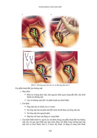 NGOẠI KHOA LÂM SÀNG-2007
Hình 3- Mở ống mật chủ lấy sỏi và đặt ống dẫn lưu T
Các phẫu thuật dẫn lưu đường mật:
o Mục đích:
Điều trị ứ đọng dịch mật, một nguyên nhân quan trọng dẫn đến việc hình
thành sỏi đường mật
Lấy sỏi đường mật (đối với phẫu thuật tạo hình Oddi)
o Chỉ định:
Ống mật chủ có nhiều sỏi (≥ 6 mm)
Sỏi ống mật chủ tái phát trên BN trước đó đã được mở ống mật chủ
Sỏi ống mật chủ nguyên phát
Hẹp hay rối loạn vận động cơ vòng Oddi
o Tạo hình Oddi (hình 4): ngoài các chỉ định chung của phẫu thuật dẫn lưu đường
mật, lấy sỏi qua ngả Oddi qua ngả trước được chỉ định trong trường hợp ống
mật chủ có kích thước nhỏ (≤ 6 mm). Kỹ thuật: di động tá tràng (thủ thuật
425
 