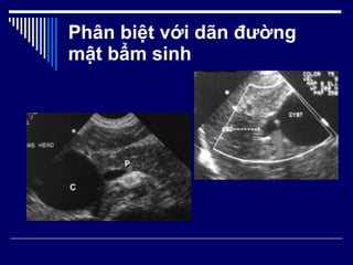 Phân biệt với dãn đường mật bẩm sinh 