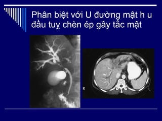 Phân biệt với U đường mật h u đầu tuỵ chèn ép gây tắc mật 