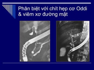 Phân biệt với chít hẹp cơ Oddi & viêm xơ đường mật 
