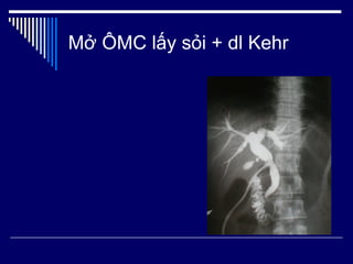 Mở ÔMC lấy sỏi + dl Kehr 