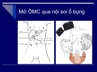 Mở ÔMC qua nội soi ổ bụng 
