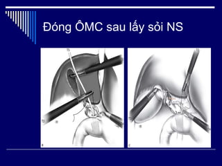 Đóng ÔMC sau lấy sỏi NS 