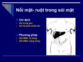 Nối mật- ruột trong sỏi mật Chỉ định Sỏi trong gan Sỏi tái phát nhiều lần Phương pháp Nối ÔMC- tá tràng Nối ÔMC- hổng tràng 