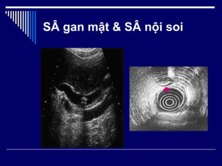 SÂ gan mật & SÂ nội soi 
