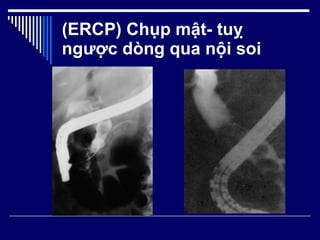(ERCP) Chụp mật- tuỵ ngược dòng qua nội soi 