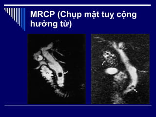 MRCP (Chụp mật tuỵ cộng hưởng từ) 