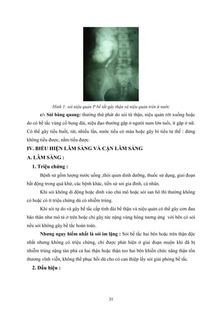 31
Hình 1: sỏi niệu quản P bế tắt gây thận và niệu quản trên ứ nước
c/- Sỏi bàng quang: thường thứ phát do sỏi từ thận, niệu quản rớt xuống hoặc
do có bế tắc vùng cố bọng đái, niệu đạo thường gặp ở người nam lớn tuổi, ít gặp ở nữ.
Có thể gây tiểu buốt, rát, nhiều lần, nước tiểu có máu hoặc gây bí tiểu tư thế : đứng
không tiểu được, nằm tiểu được.
IV. BIỂU HIỆN LÂM SÀNG VÀ CẬN LÂM SÀNG
A. LÂM SÀNG :
1. Triệu chứng :
Bệnh sử gồm lượng nước uống ,thói quen dinh dưỡng, thuốc sử dụng, giai đoạn
bất động trong quá khứ, các bệnh khác, tiền sử sỏi gia đình, cá nhân.
Khi sỏi không di động hoặc dính vào chủ mô hoặc sỏi san hô thì thường không
có hoặc có ít triệu chứng dù có nhiễm trùng.
Khi sỏi tự do và gây bế tắc cấp tính đài bể thận và niệu quản có thể gây cơn đau
bão thân như mô tả ở trên hoặc chỉ gây tức nặng vùng hông tương ứng với bên có sỏi
nếu sỏi không gây bế tắc hoàn toàn.
Nhƣng nguy hiểm nhất là sỏi im lặng : Sỏi bế tắc hai bên hoặc trên thận độc
nhất nhưng không có triệu chứng, chỉ được phát hiện ở giai đoạn muộn khi đã bị
nhiễm trùng nặng tàn phá cả hai thận hoặc thận teo hai bên khiến chức năng thận tổn
thương vĩnh viễn, không thể phục hồi dù cho có can thiệp lấy sỏi giải phóng bế tắc.
2. Dấu hiệu :
 