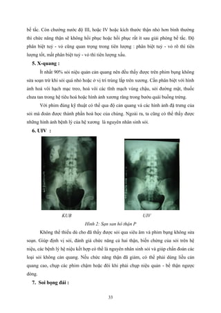 33
bế tắc. Còn chướng nước độ III, hoặc IV hoặc kích thước thận nhỏ hơn bình thường
thì chức năng thận sẽ không hồi phục hoặc hồi phục rất ít sau giải phóng bế tắc. Độ
phân biệt tuỷ - vỏ cũng quan trọng trong tiên lượng : phân biệt tuỷ - vỏ rõ thì tiên
lượng tốt, mất phân biệt tuỷ - vỏ thì tiên lượng xấu.
5. X-quang :
Ít nhất 90% sỏi niệu quản cản quang nên đều thấy được trên phim bụng không
sửa soạn trừ khi sỏi quá nhỏ hoặc ở vị trí trùng lắp trên xương. Cần phân biệt với hình
ảnh hoá vôi hạch mạc treo, hoá vôi các tĩnh mạch vùng chậu, sỏi đường mật, thuốc
chưa tan trong hệ tiêu hoá hoặc hình ảnh xương răng trong bướu quái buồng trứng.
Với phim đúng kỹ thuật có thể qua độ cản quang và các hình ảnh đặ trưng của
sỏi mà đoán được thành phần hoá học của chúng. Ngoài ra, ta cũng có thể thấy được
những hình ảnh bệnh lý của hệ xương là nguyên nhân sinh sỏi.
6. UIV :
KUB UIV
Hình 2: Sạn san hô thận P
Không thể thiếu dù cho đã thấy được sỏi qua siêu âm và phim bụng không sửa
soạn. Giúp định vị sỏi, đánh giá chức năng cả hai thận, biến chứng của sỏi trên hệ
niệu, các bệnh lý hệ niệu kết hợp có thể là nguyên nhân sinh sỏi và giúp chẩn đoán các
loại sỏi không cản quang. Nếu chức năng thận đã giảm, có thể phải dùng liều cản
quang cao, chụp các phim chậm hoặc đôi khi phải chụp niệu quản - bể thận ngược
dòng.
7. Soi bọng đái :
 