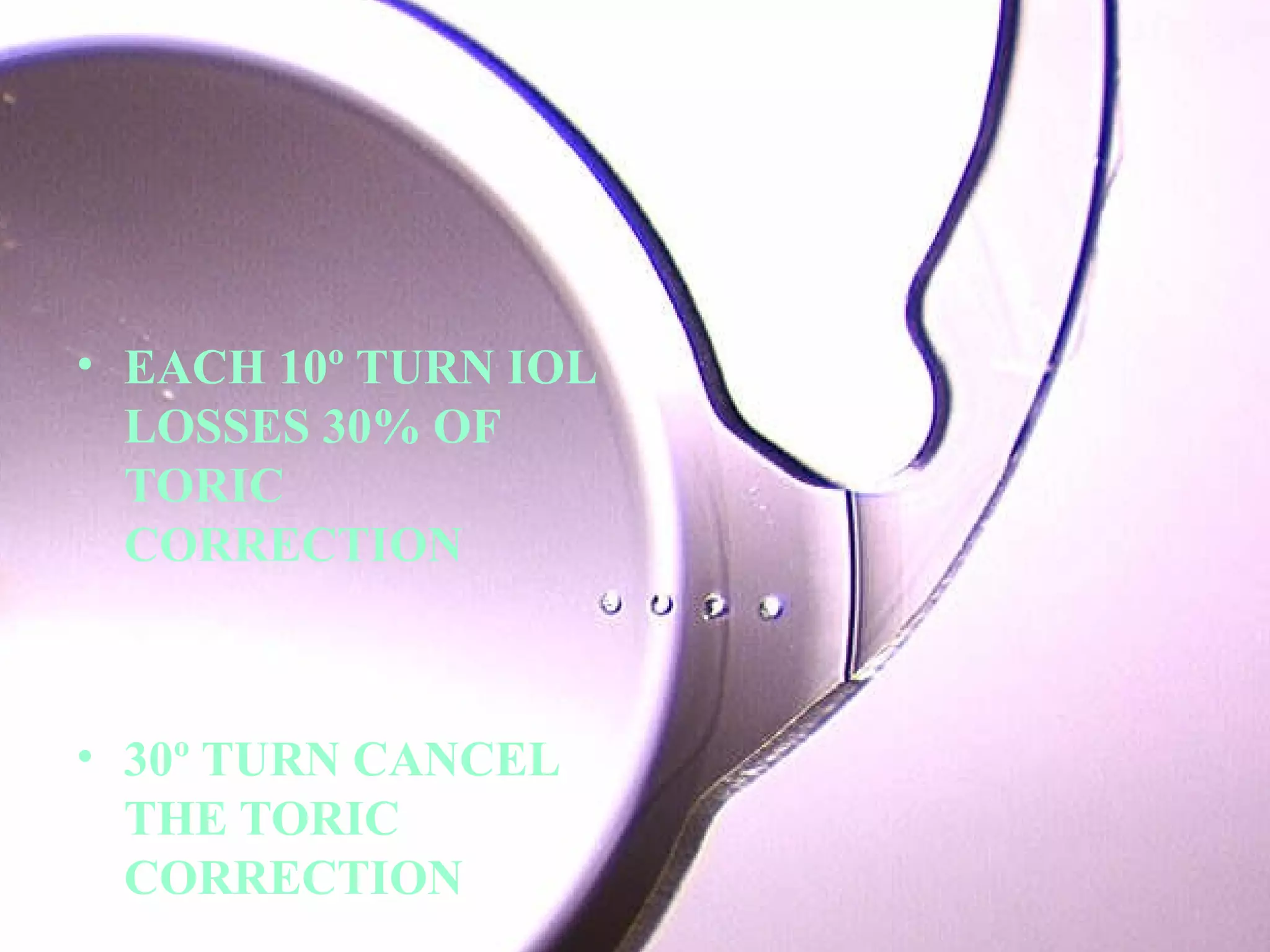 • EACH 10º TURN IOL
LOSSES 30% OF
TORIC
CORRECTION

• 30º TURN CANCEL
THE TORIC
CORRECTION

 