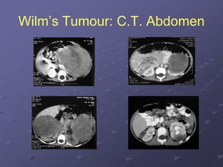 Wilm’s Tumour: C.T. Abdomen
 