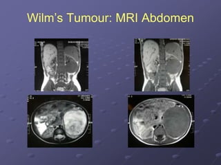 Wilm’s Tumour: MRI Abdomen
 