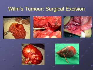 Wilm’s Tumour: Surgical Excision
 