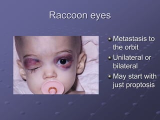 Raccoon eyes
Metastasis to
the orbit
Unilateral or
bilateral
May start with
just proptosis
 