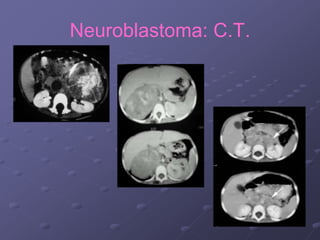 Neuroblastoma: C.T.
 
