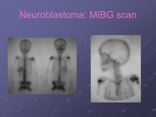Neuroblastoma: MIBG scan
 