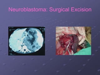 Neuroblastoma: Surgical Excision
 