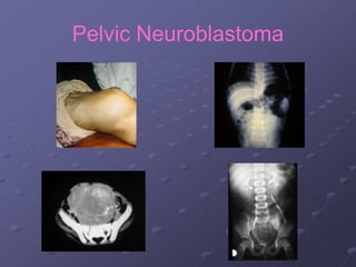 Pelvic Neuroblastoma
 