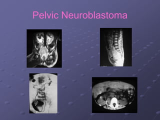 Pelvic Neuroblastoma
 
