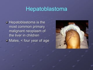Hepatoblastoma
Hepatoblastoma is the
most common primary
malignant neoplasm of
the liver in children
Males, < four year of age
 