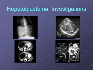 Hepatoblastoma: Investigations
 