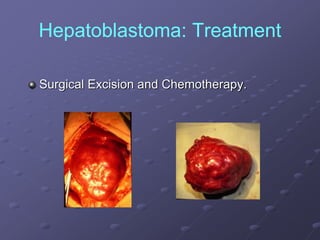 Hepatoblastoma: Treatment
Surgical Excision and Chemotherapy.
 
