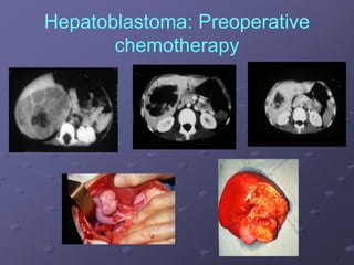 Hepatoblastoma: Preoperative
chemotherapy
 