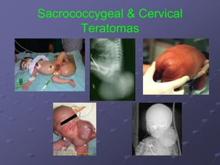 Sacrococcygeal & Cervical
Teratomas
 