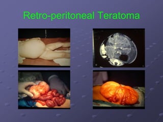 Retro-peritoneal Teratoma
 