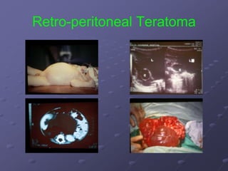 Retro-peritoneal Teratoma
 