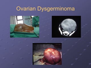 Ovarian Dysgerminoma
 
