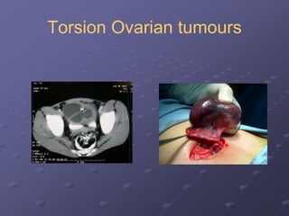 Torsion Ovarian tumours
 