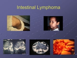 Intestinal Lymphoma
 