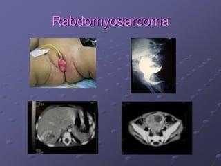 Rabdomyosarcoma
 