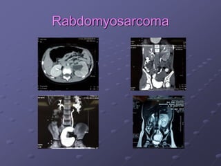 Rabdomyosarcoma
 