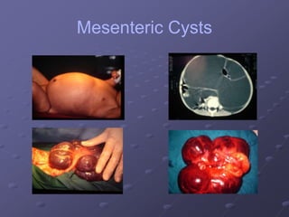 Mesenteric Cysts
 