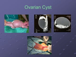 Ovarian Cyst
 